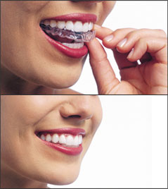 Invisalign | Xavier Leos Family Dentistry | Brownsville, TX