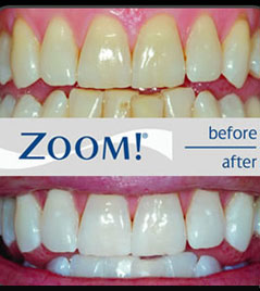 Before & After Zoom Teeth Whitening | Xavier Leos Family Dentistry | Brownsville, TX